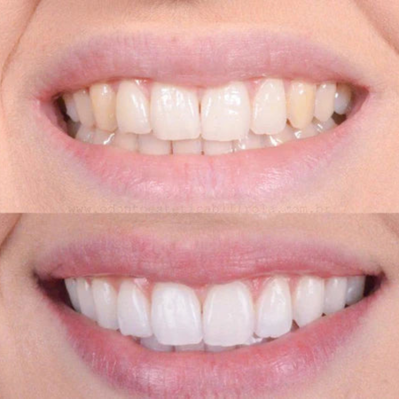 Fast Teeth Whitening for a Radiant Smile