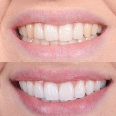 Fast Teeth Whitening for a Radiant Smile